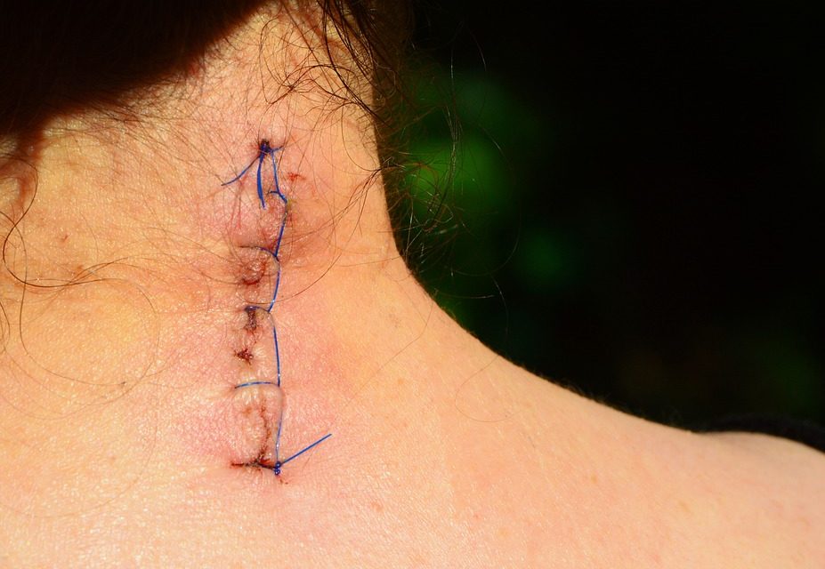 Važnost rehabilitacije ožiljka nakon operativnog zahvata