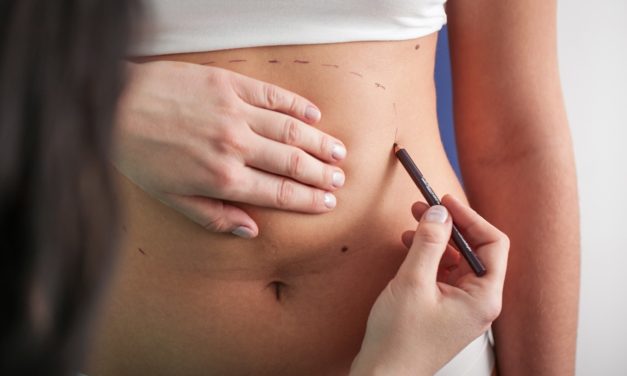 Brza i bezbolna liposukcija postala je svjetski hit